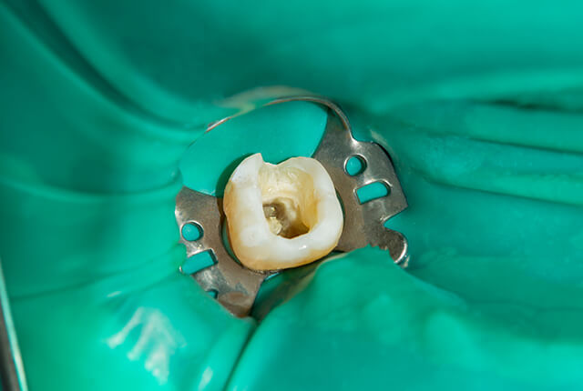 根管治療に 2 回の訪問が必要になる場合があるのはなぜですか?